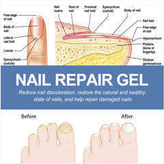 Nail Fungus Repair Gel